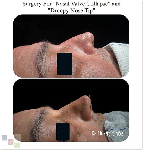 Nasal Valve Collapse and Treatment