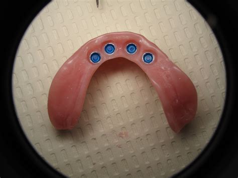 Dental Implant Overdenture Locator Attachments…Patient Information ...