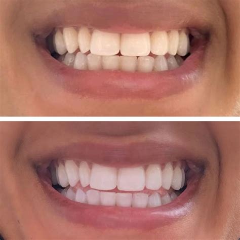 Smile White Teeth Whitening Review: Best for Professional Results