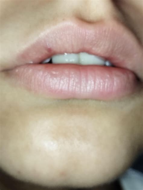 Red dot on lip for months, should I be worried? : r/askdentists