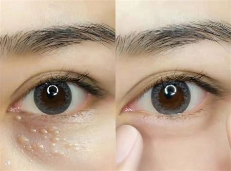 Why Do Milia Appear Around the Eyes and Face? - Midas Wellness Hub