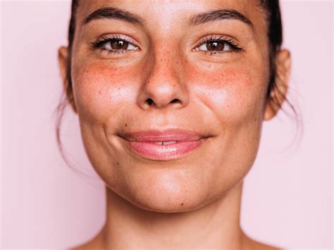 Redness Across Cheeks And Nose Rosacea, Redness And Flushing