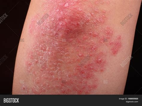 What Is Bumpy Rash On Elbow at Joanne Magana blog