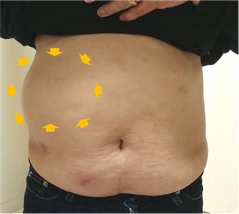 At-a-glance diagnosis of postherpetic abdominal pseudohernia - International Journal of ...