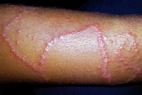 First Aid Treatment for Jellyfish Stings