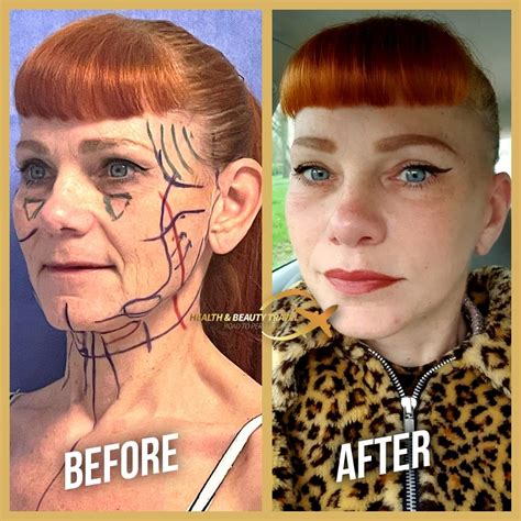 What Is Deep Plan Facelift Surgery? - Health & Beauty Travel