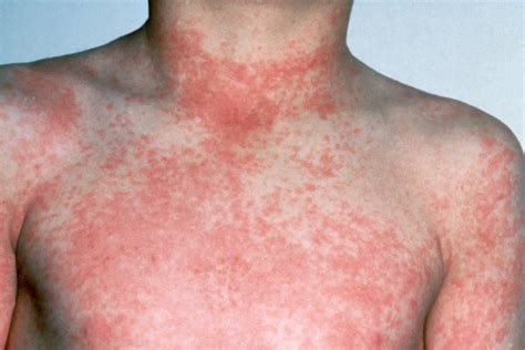 What Do Fever Rashes Look Like - Infoupdate.org