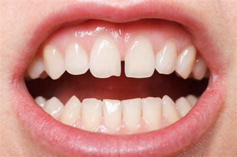 Fix a Chipped Tooth at Home: Easy Tips and Tricks