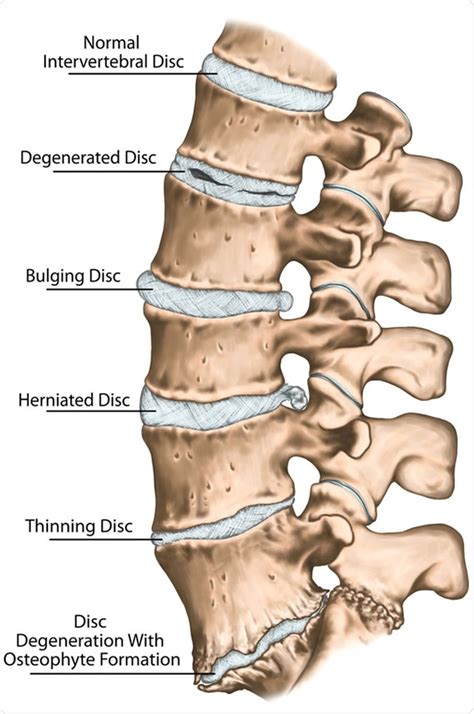 Degenerative Disc Disease Treatment and Self-Care
