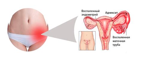 Болит яичник справа причины