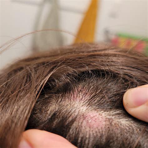 Scalp Rash And Bumps at Roy Lujan blog