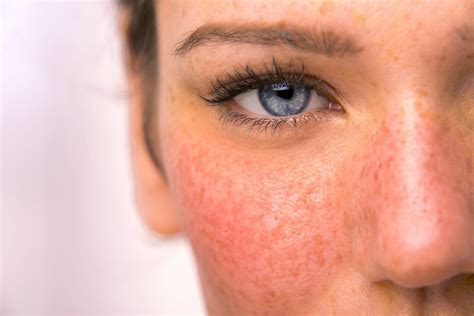 Rosacea Treatment - Melbourne | Victorian Laser & Skin Clinic