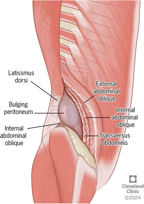 Complex blunt traumatic abdominal wall hernias: Experience from a high-volume abdominal core ...