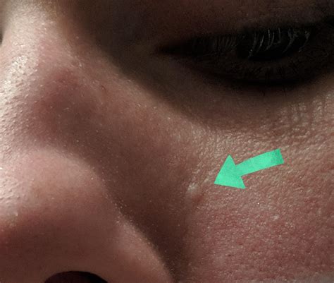 White Spots On Skin Go Away at Lauren Murphy blog
