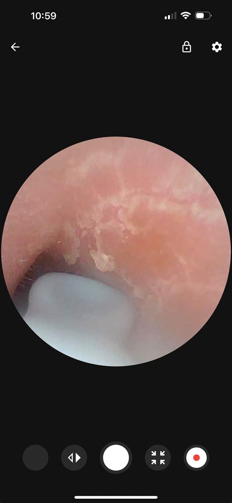 Psoriasis, eczema, or dermatitis in ear canal? : r/seborrheicdermatitis