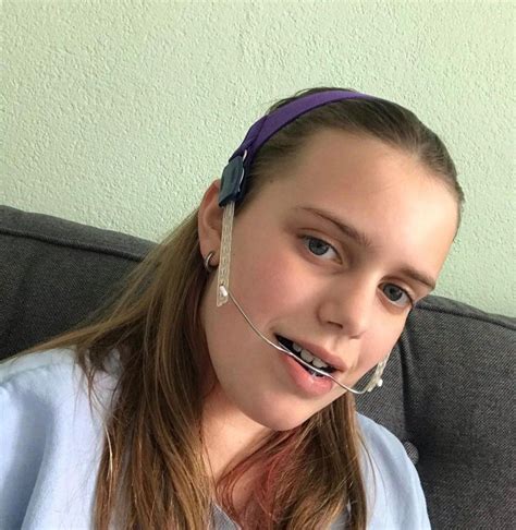 Orthodontic Headgear at Michelle Peckham blog