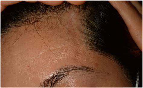 Dacryoadenitis associated with linear scleroderma en coup de sabre: A ...