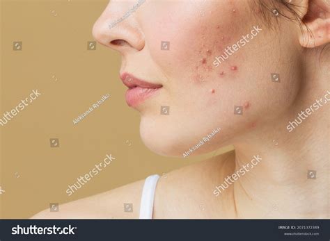 Bad Acne Skin