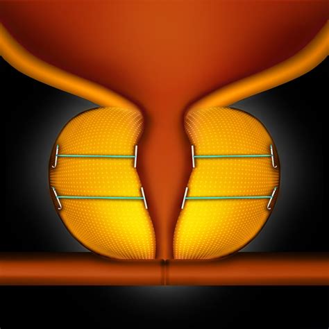 Orlando Urologists Offer Breakthrough Treatment for Men Suffering Enlarged Prostate