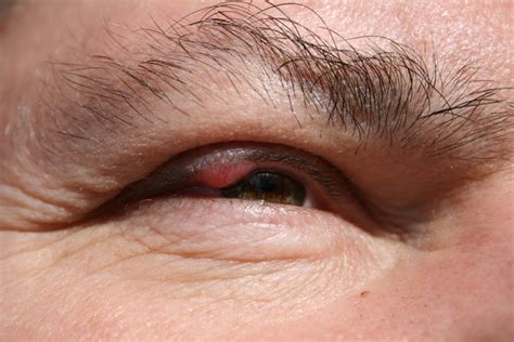 Eyelid inflammation (blepharitis) causes, symptoms, and treatment