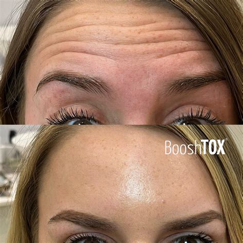 What Is Baby Botox