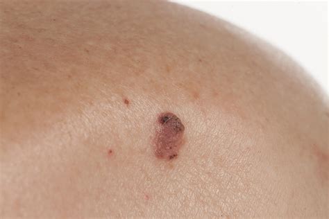Skin Cancer Removal - Glick Skin Institute