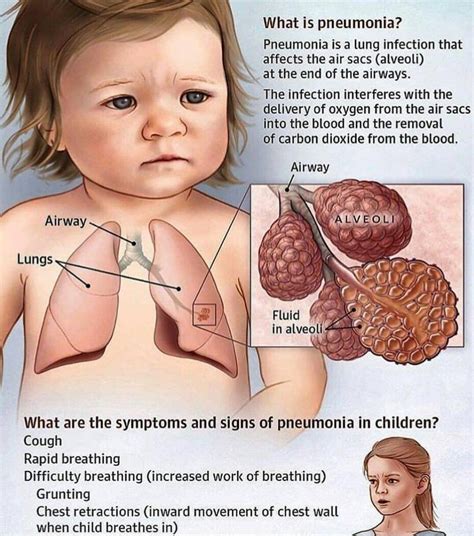 Symptoms Of Pneumonia In Children
