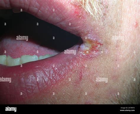 Angular cheilitis, also known as angular stomatitis, is an inflammatory ...