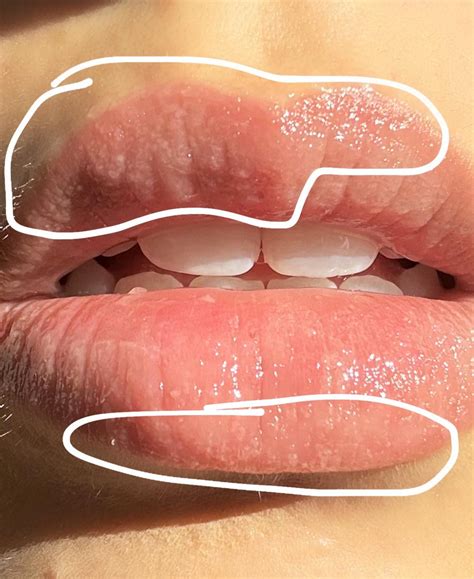 Itchy lip bumps-oozing clear fluid, not cold sores. HELP!! : r/Accutane