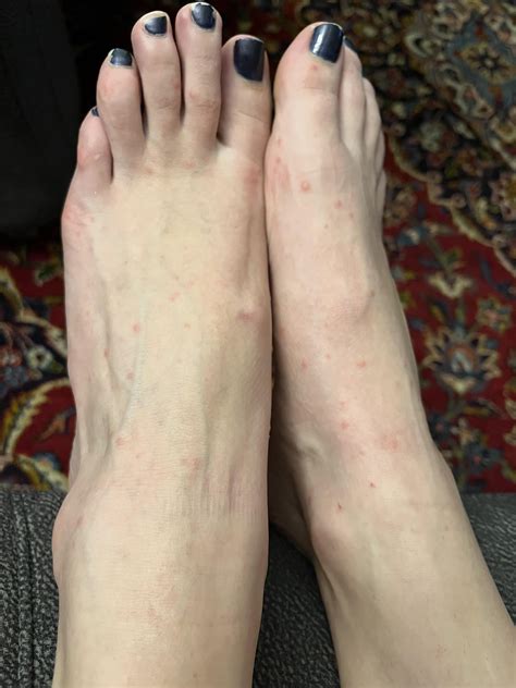 Red bumps on back of hands and feet. : r/Dermatology
