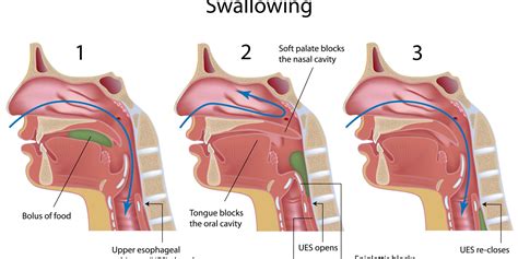 Early Intervention In Speech & Swallowing Disorders