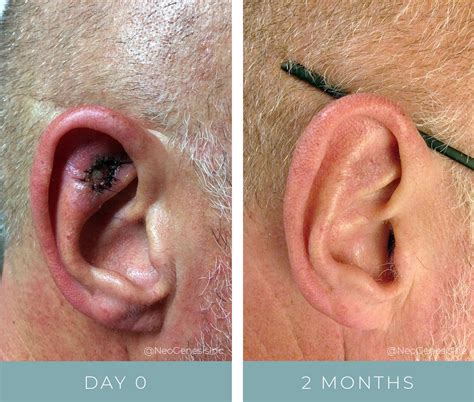 Squamous Cell Carcinoma Mohs Surgery Before + After Photos