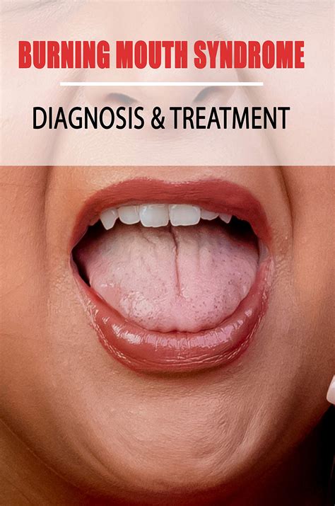 Burning Mouth Syndrome: Diagnosis & Treatment: Burning Mouth Syndrome Guide by Enoch Narciso ...