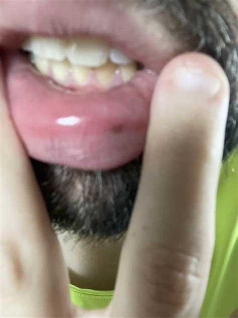 Freckle on lower lip : r/DermatologyQuestions