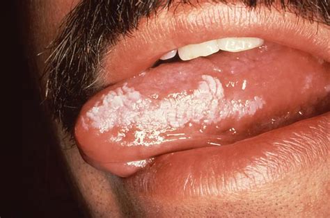 White Spots on Tongue: 7 Pictures to Compare Symptoms