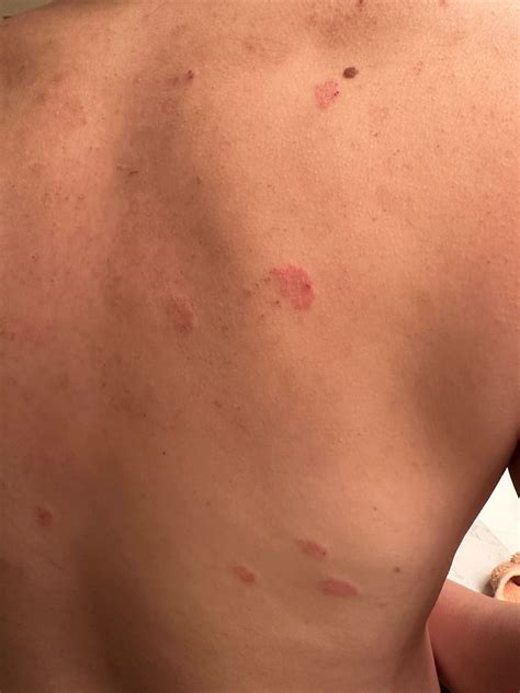 Eczema in pregnancy | BabyCenter