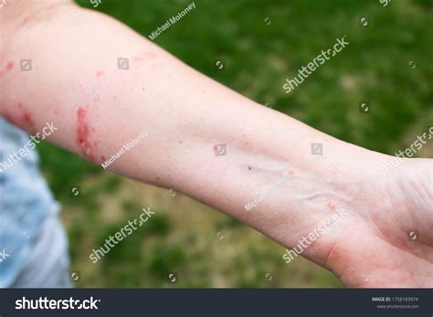 Infection Poison Ivy Allergic Reaction On Stock Photo (Edit Now) 1758183974
