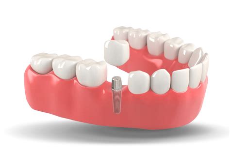 Dental Implant PNG Transparent Image - dental implant images
