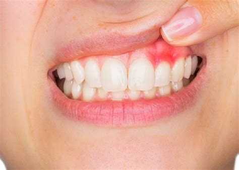 Gum Disease: How can I prevent it? How does it affect my body?