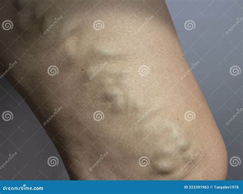 Varicose veins in the leg stock image. Image of enlarged - 223391963
