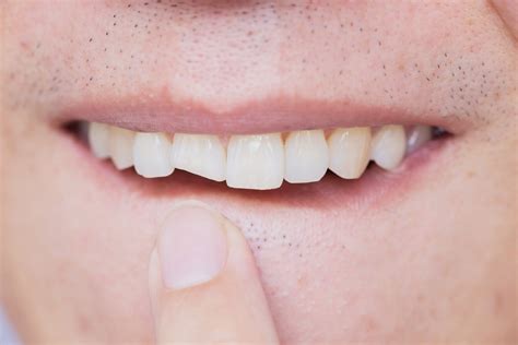 Chipped Front Tooth