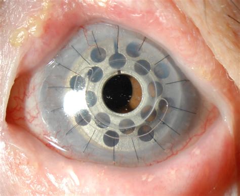 Prosthetic Cornea Osteo Odonto Keratoprosthesis Surgery (OOKP)