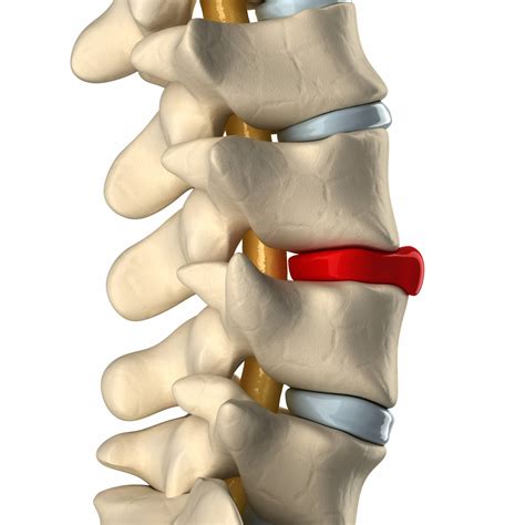 Herniated Disc Doctor in NYC? | Physical Therapy in Manhattan, NYC