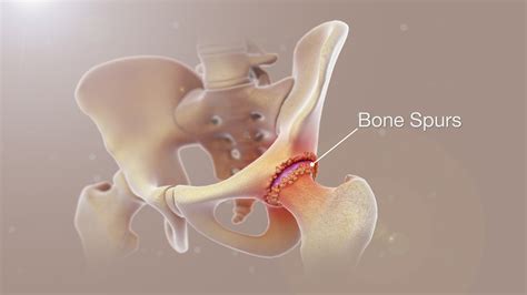 Bone Spurs Shown and Explained Using Medical Animation Still Shot