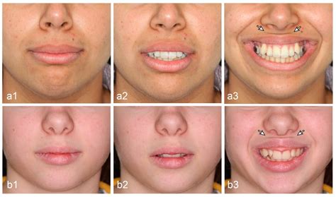 Upper Lip Medical Term