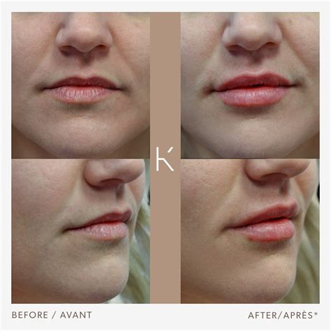 Lip Augmentation | Schwarz Plastic Surgery Clinic in Montreal