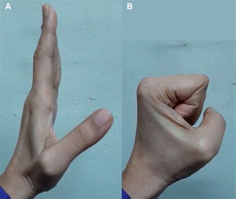 Flexor tendon laceration of the hand from opening a glass ampoule | BMJ ...