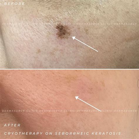 Cryotherapy For Seborrheic Keratoses