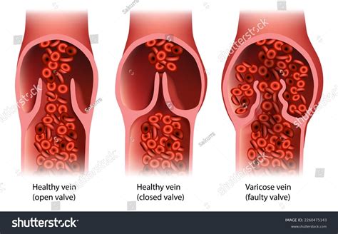 Chronic Venous Insufficiency Venous Refluxvenous Disease Stock Vector (Royalty Free) 2260475143 ...