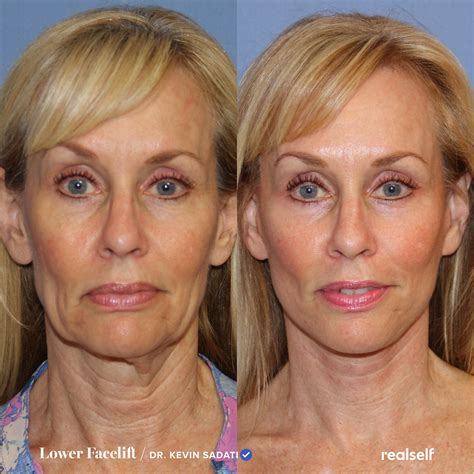 Lower Facelift vs. Neck Lift: What’s the Difference? in 2024 | Lower face lift surgery, Face ...
